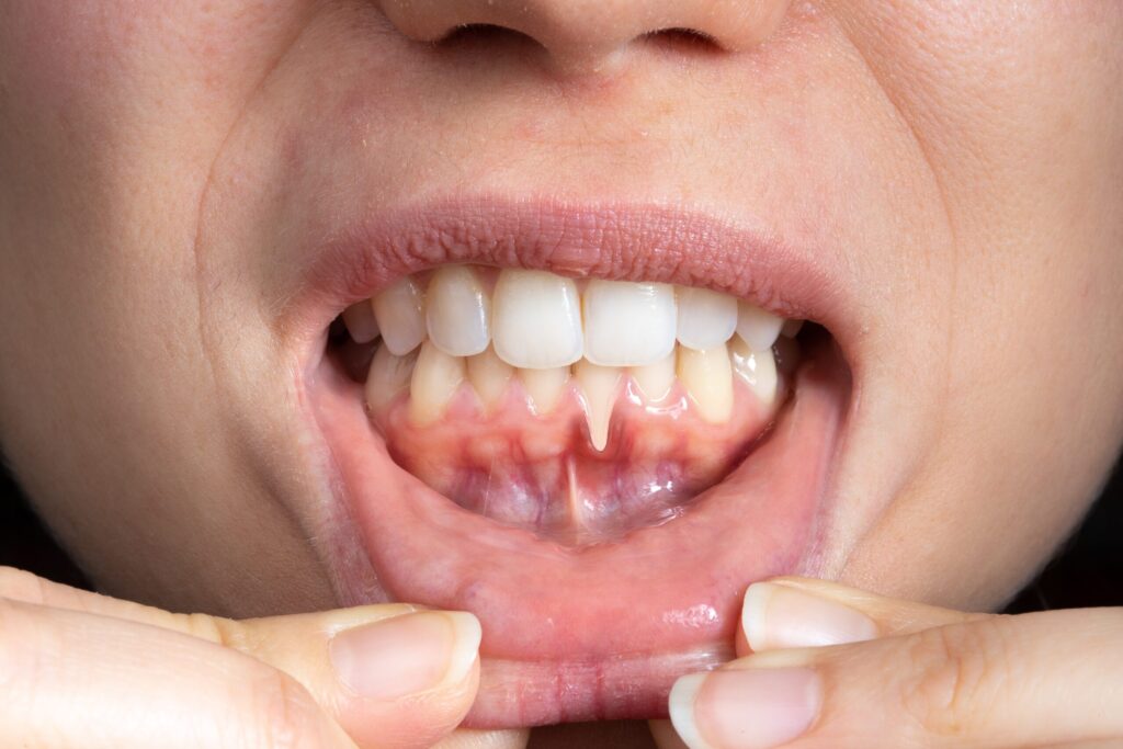 Preparing for teeth whitening with receding gums Reigate